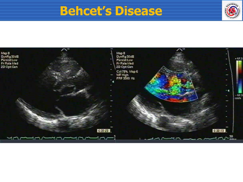 Behcet’s Disease